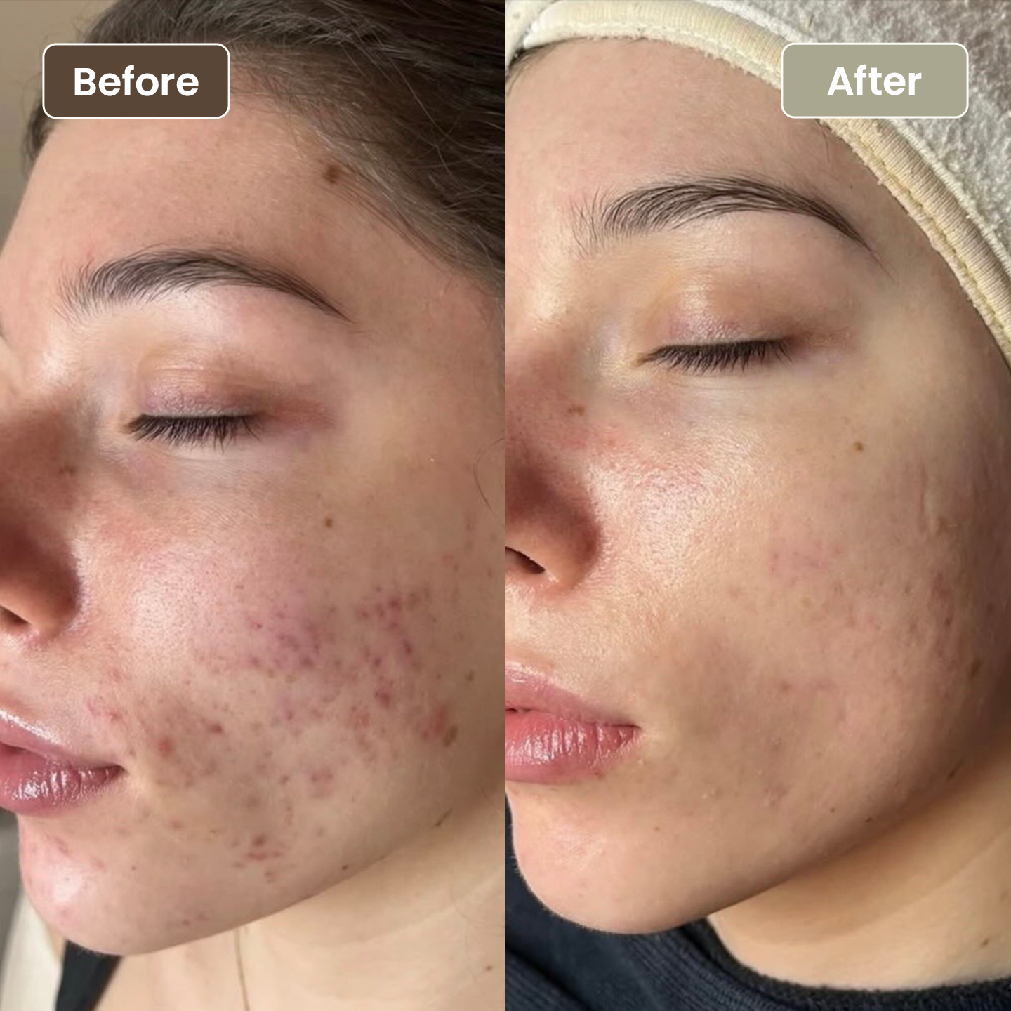 Before and after acne and post-inflammatory redness improvement, Aesthetic Artistry Skin Wollongong