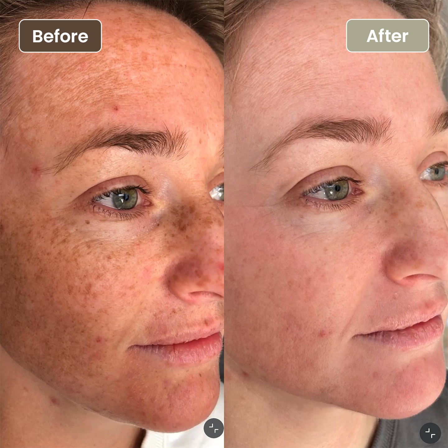 Before and after sun damage and pigmentation improvement, Aesthetic Artistry Skin Wollongong