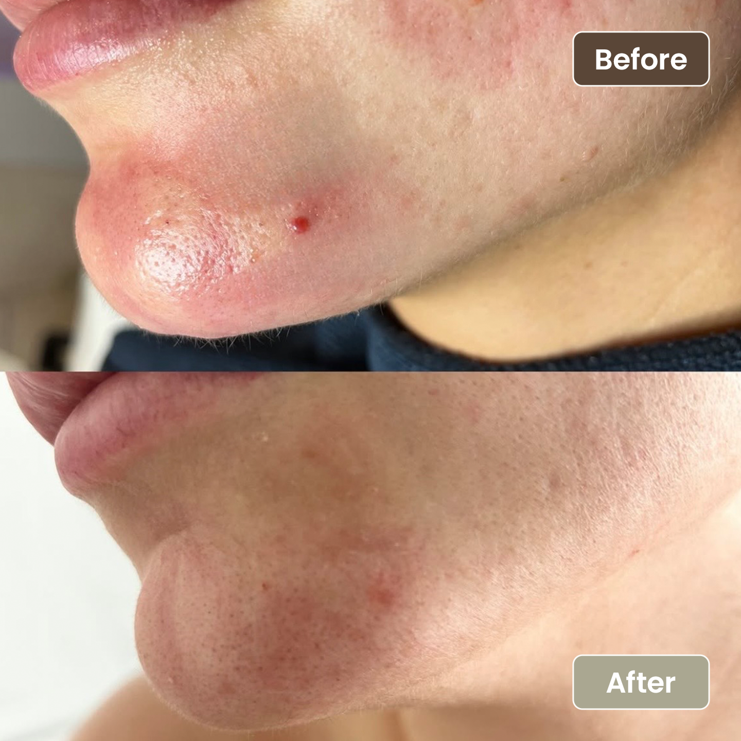 Before and after lesion removal on the chin, Aesthetic Artistry Skin Wollongong