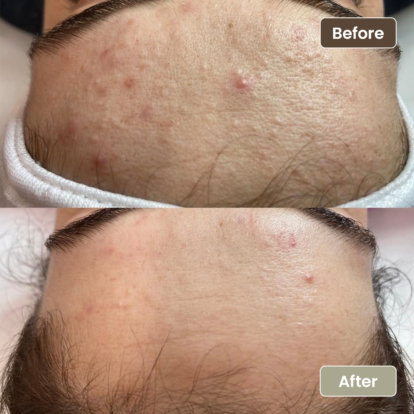 Before and after forehead congestion and breakout improvement, Aesthetic Artistry Skin Wollongong