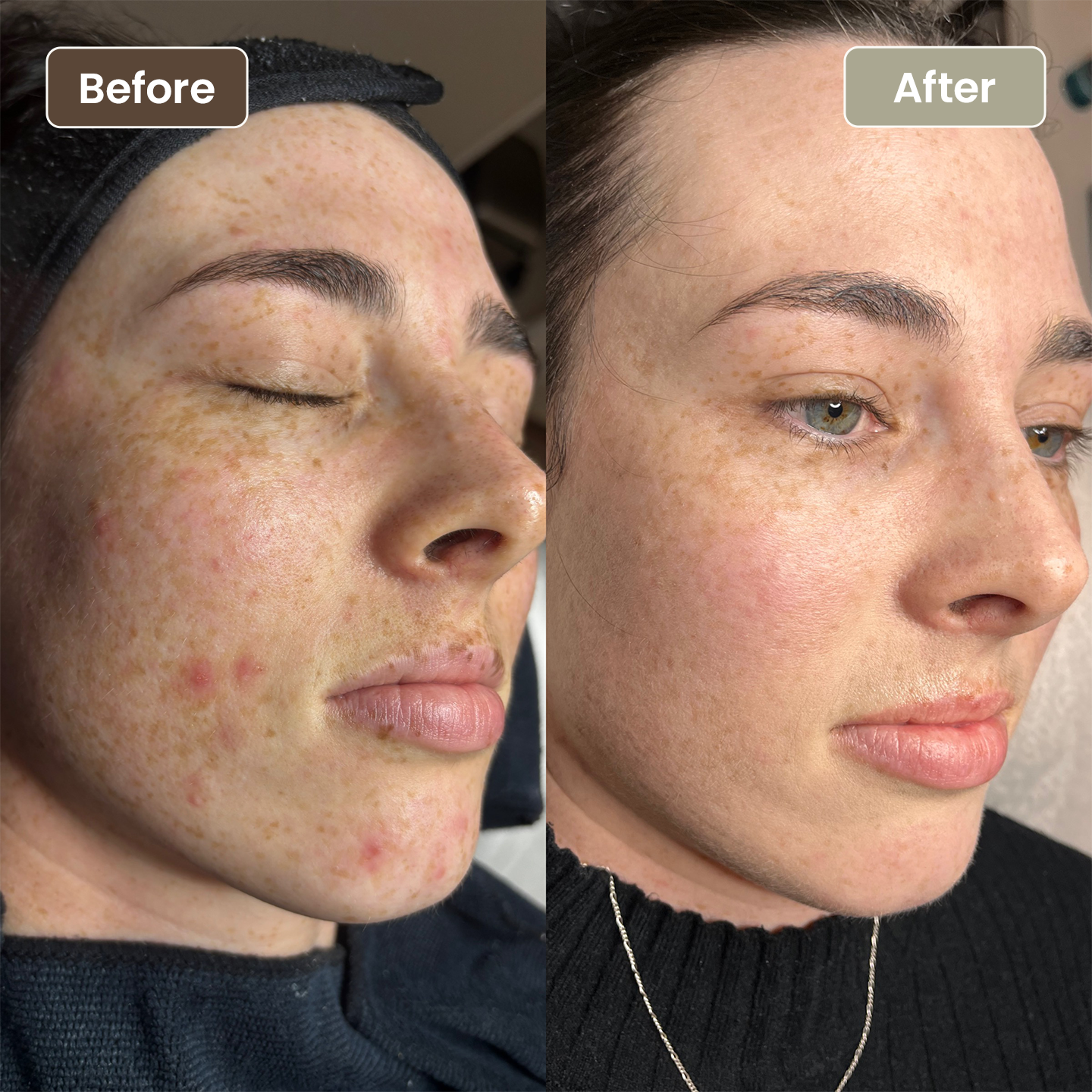 Before and after melasma and pigmentation improvement, Aesthetic Artistry Skin Wollongong