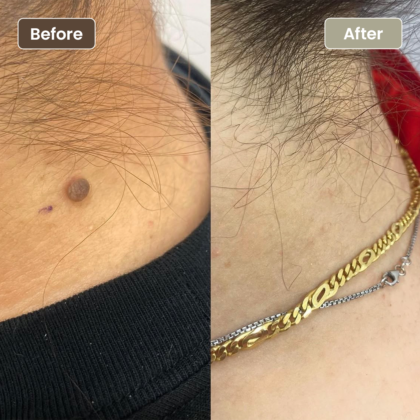 Before and after mole removal on the neck, Aesthetic Artistry Skin Wollongong