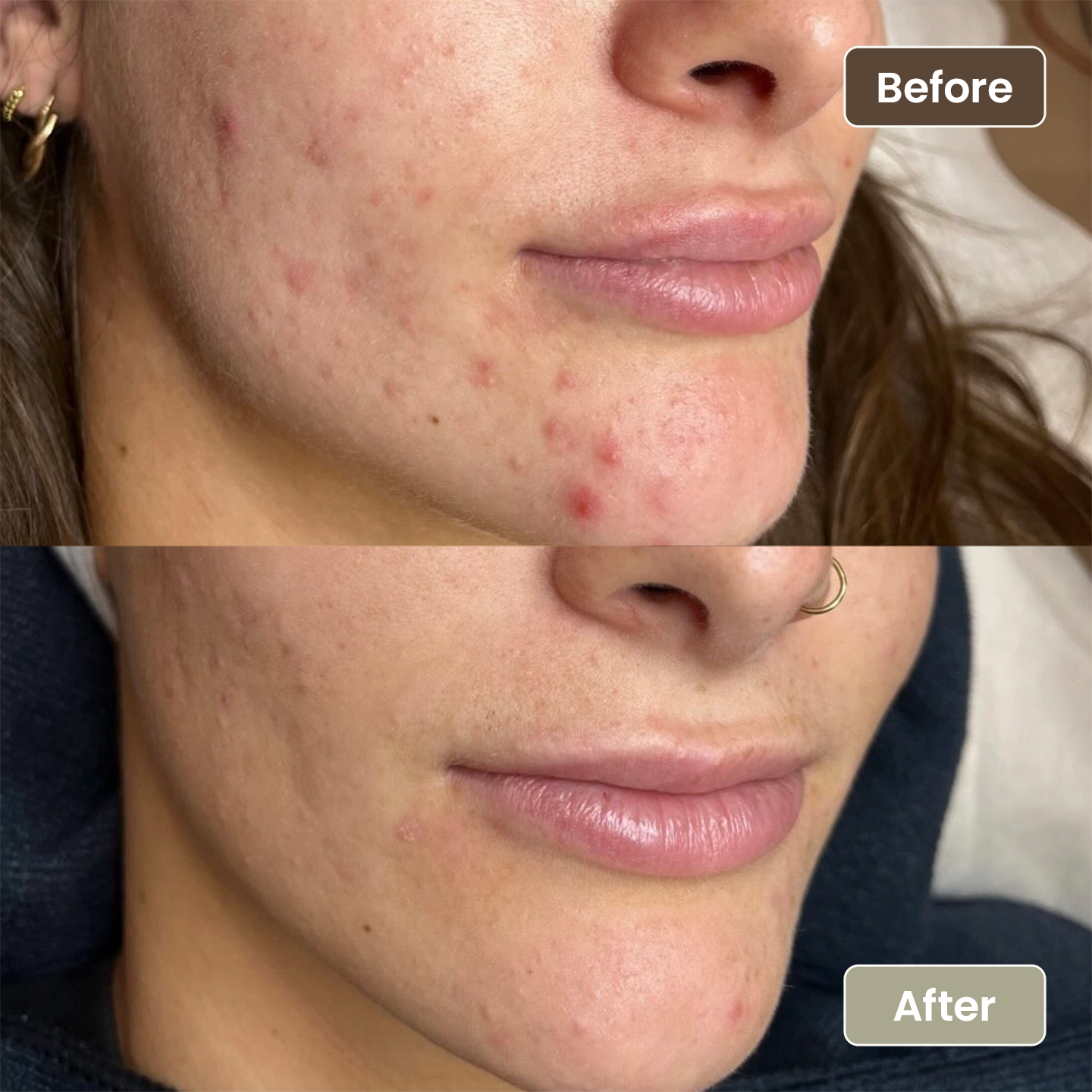 Before and after active acne clearing on the cheek, Aesthetic Artistry Skin Wollongong
