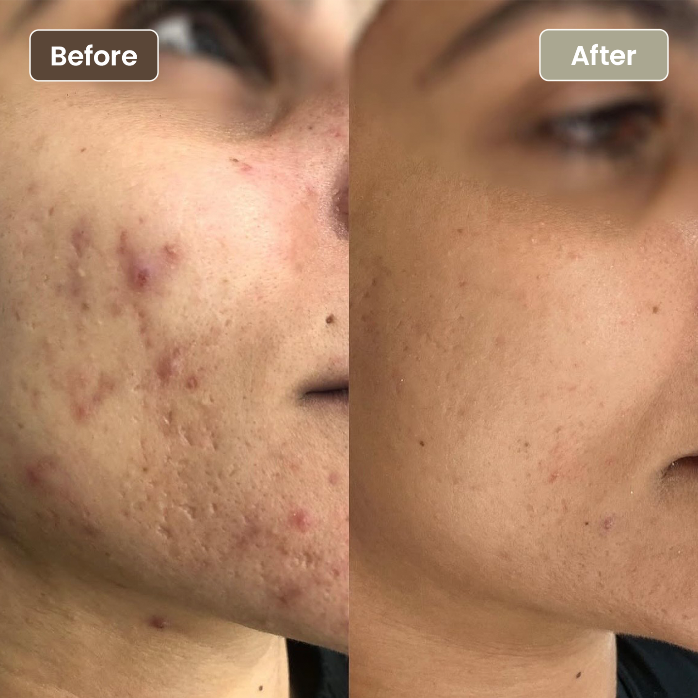 Before and after acne scarring and redness improvement, Aesthetic Artistry Skin Wollongong