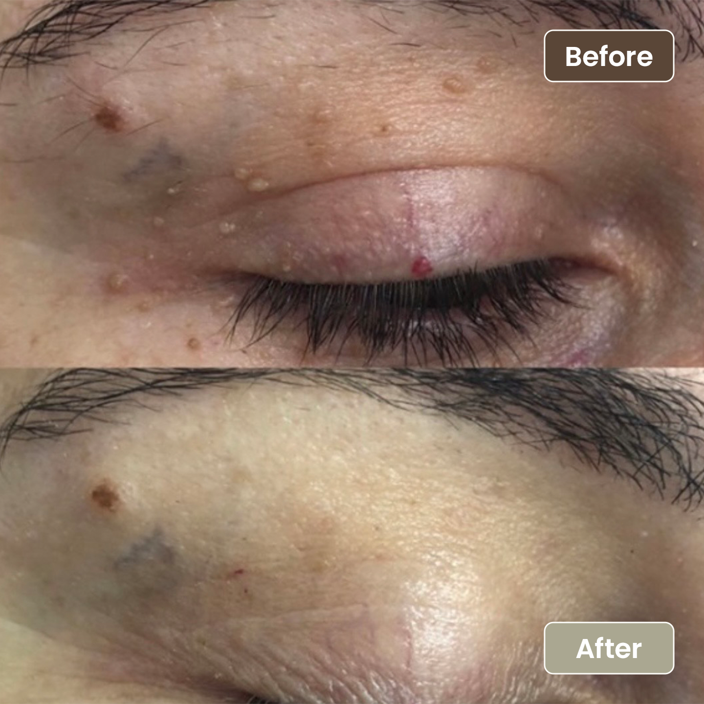 Before and after skin lesion removal near the eyelid, Aesthetic Artistry Skin Wollongong