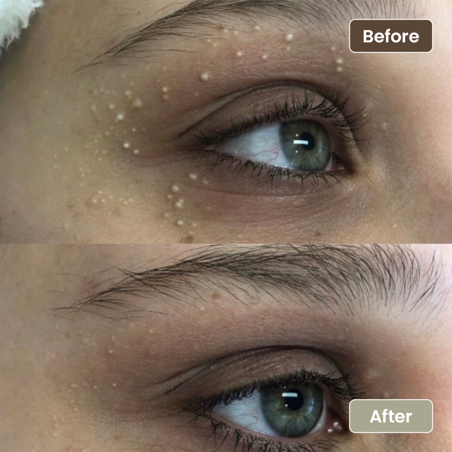 Before and after milia removal under the eye, Aesthetic Artistry Skin Wollongong