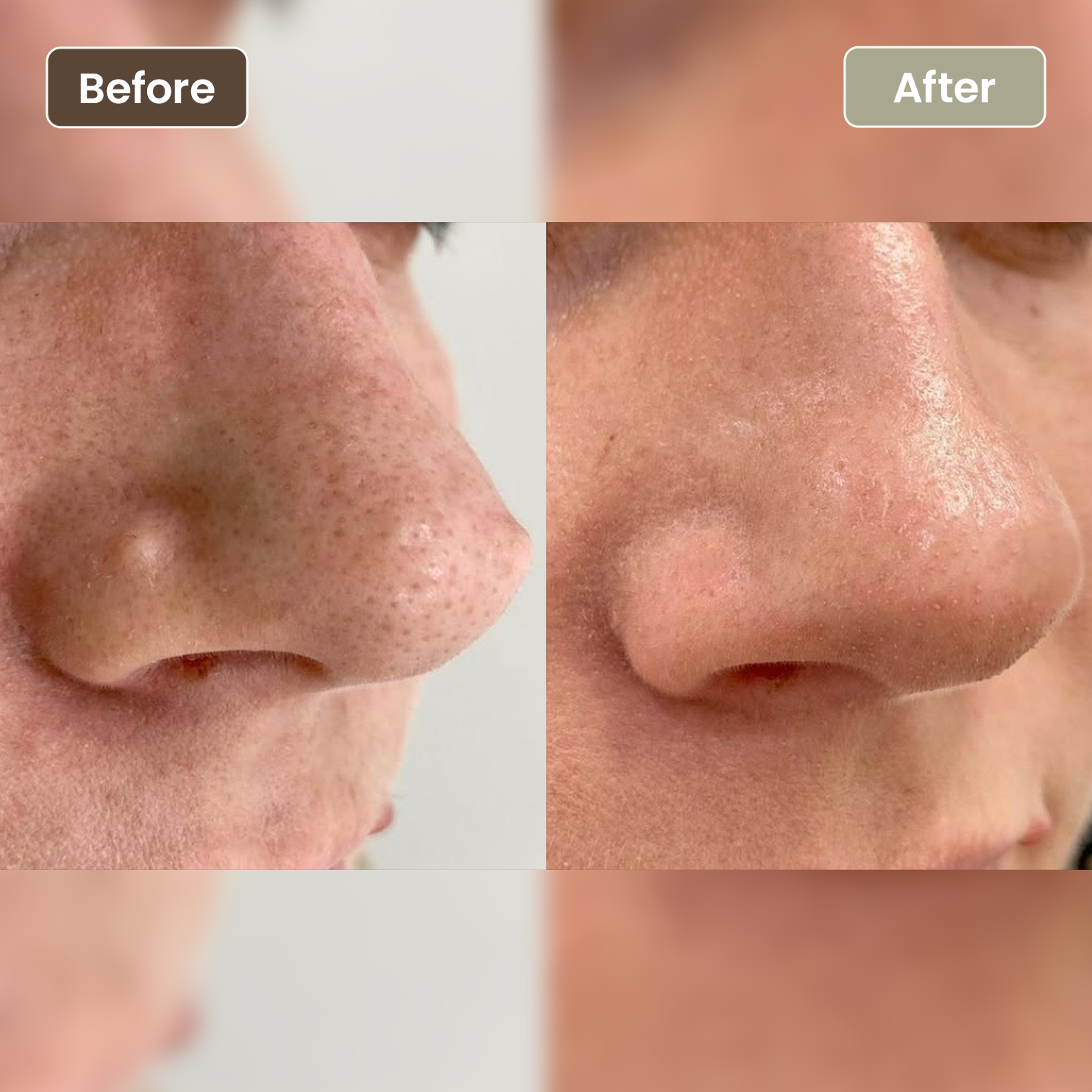 Before and after congested pores and blackhead improvement on the nose, Aesthetic Artistry Skin Wollongong