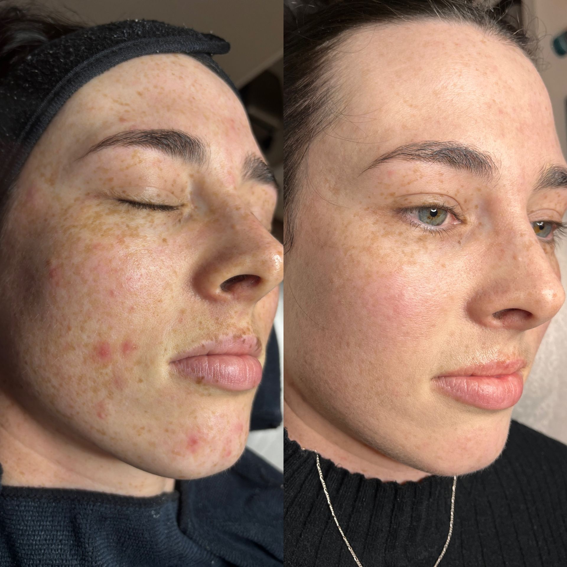 Before and after melasma and pigmentation improvement, Aesthetic Artistry Skin Wollongong