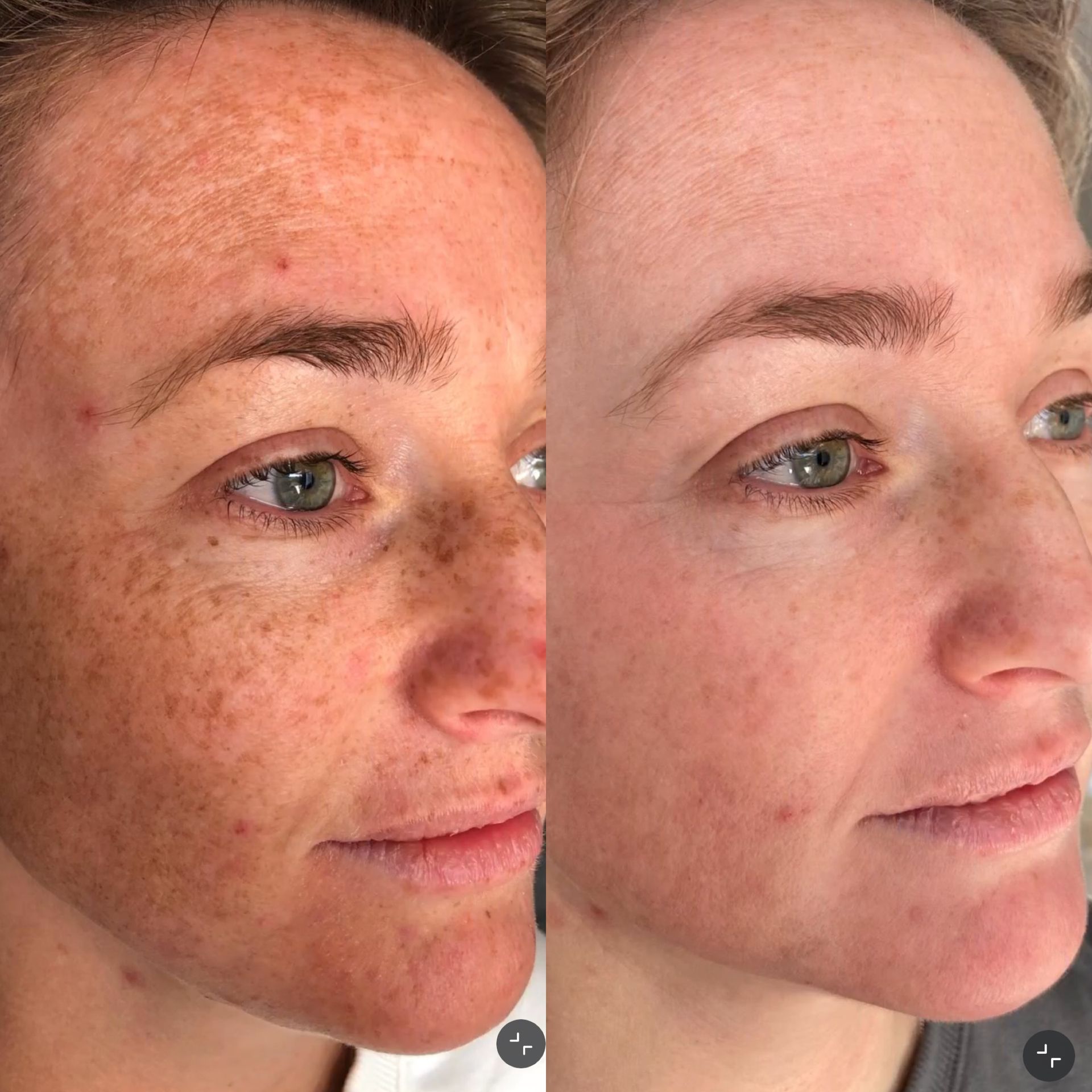 Before and after active acne clearing on the cheek, Aesthetic Artistry Skin Wollongong