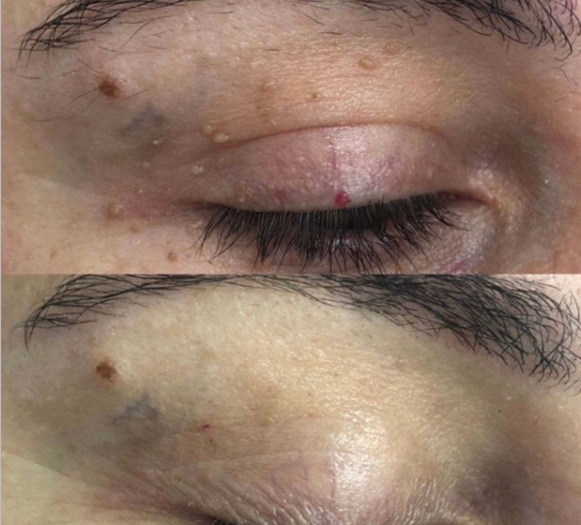 Before and after skin lesion removal near the eyelid, Aesthetic Artistry Skin Wollongong