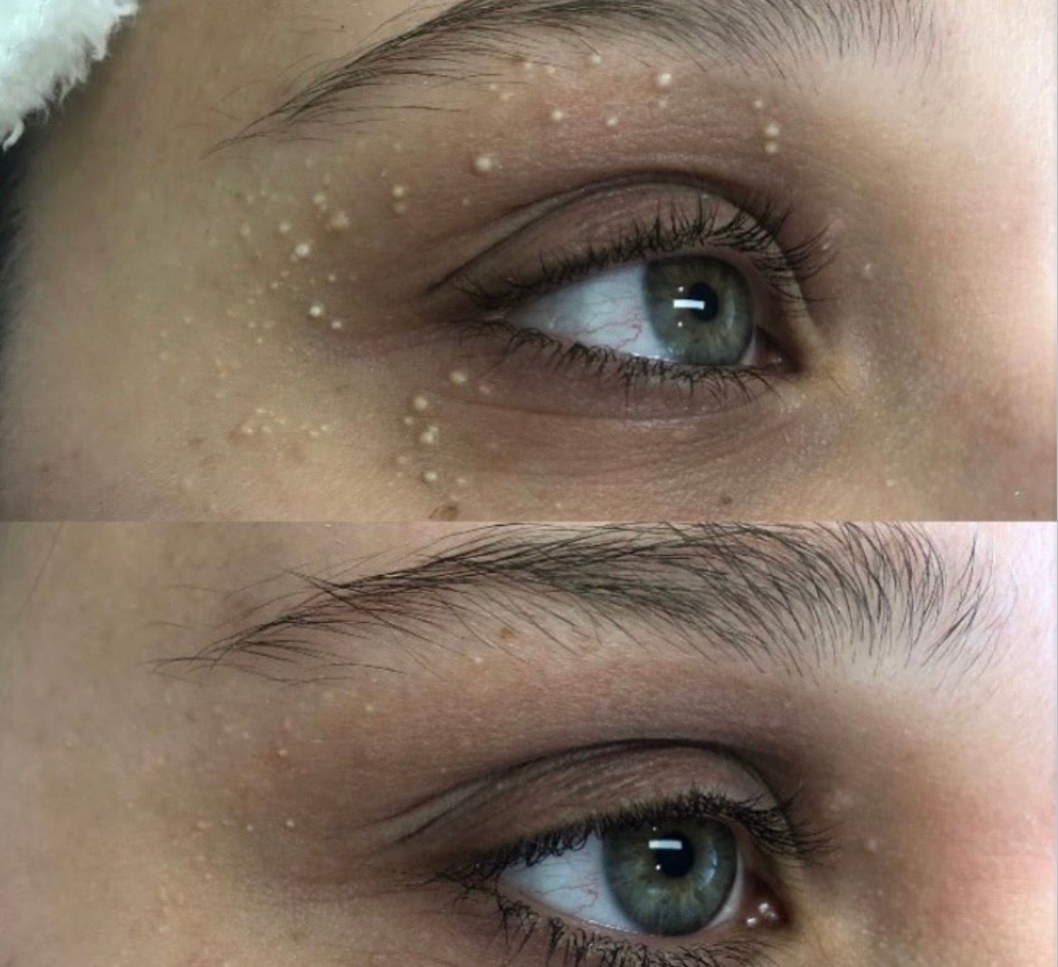 Before and after milia removal under the eye, Aesthetic Artistry Skin Wollongong