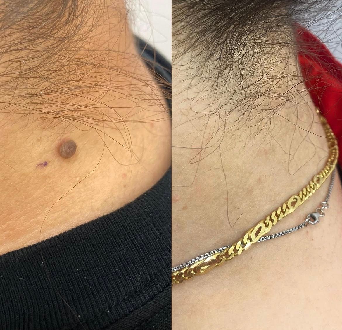 Before and after mole removal on the neck, Aesthetic Artistry Skin Wollongong