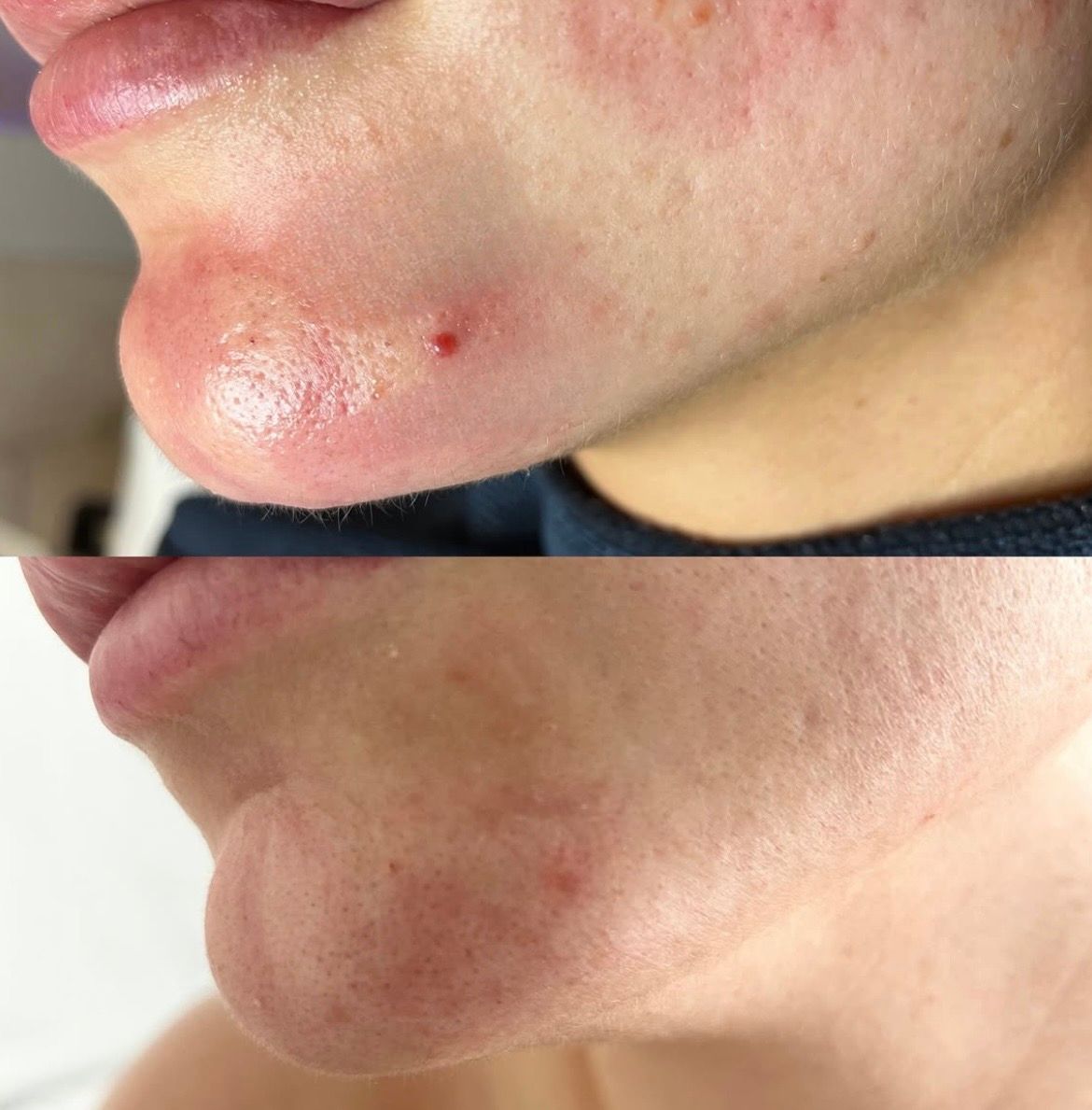 Before and after a cystic breakout resolving on the chin, Aesthetic Artistry Skin Wollongong