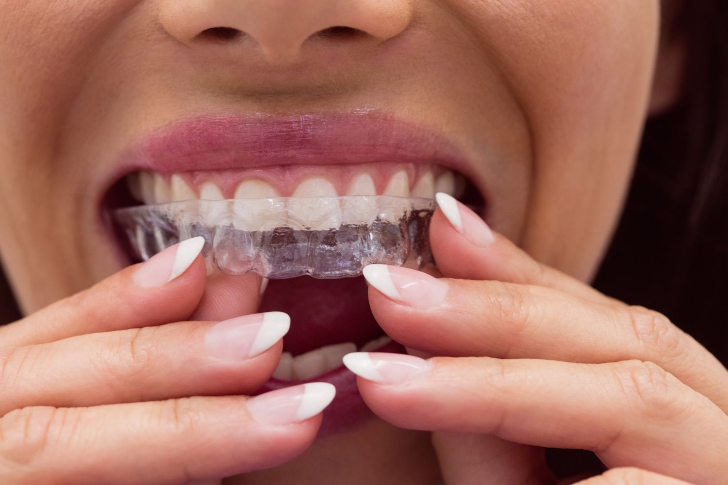 Oral Appliance Therapy