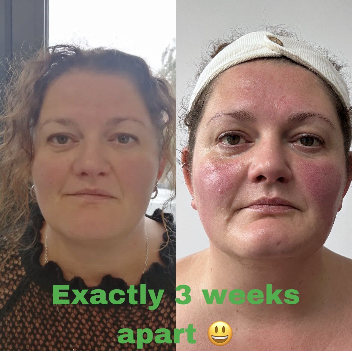 Bell Palsy and Facial Cupping