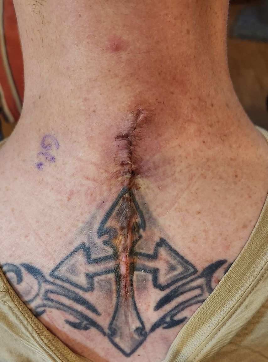 Close-up of a healing stitched wound on the back of a neck above a black tattoo