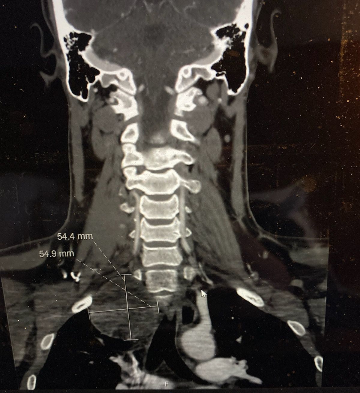 Coronal neck CT scan showing cervical spine and soft tissues with measurement markers