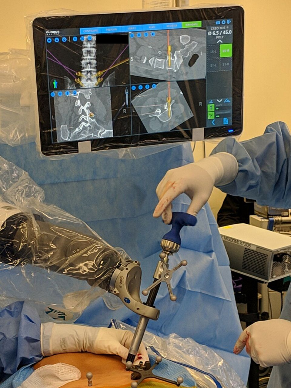 Surgical team performing minimally invasive procedure with robotic arms and monitor displaying scans