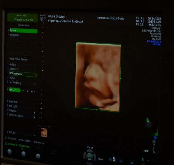 3D ultrasound of a fetus's face, side view. Displayed on a screen with text and controls.