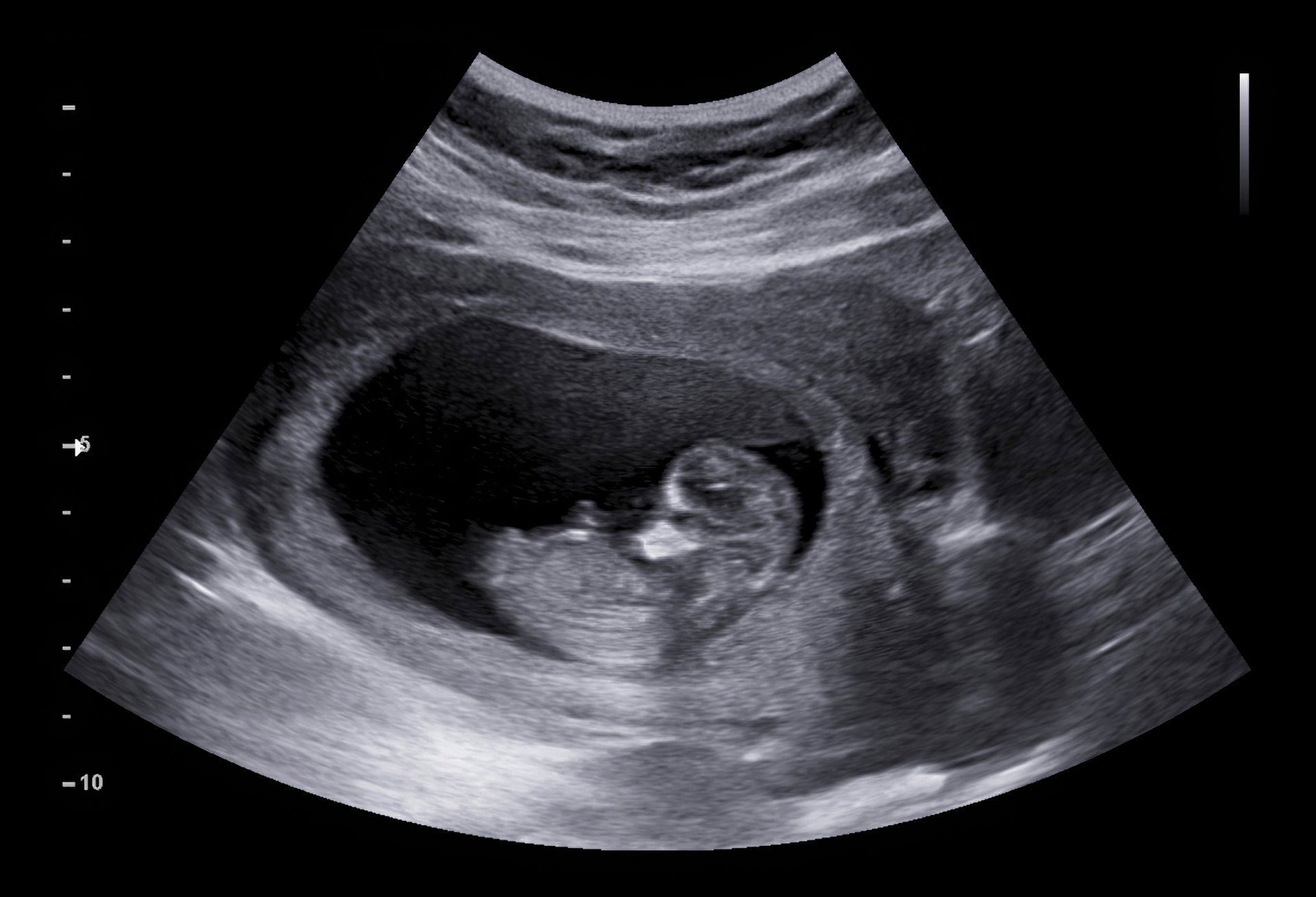 Fetal ultrasound, showing a developing baby within the womb. The fetus is in profile, with visible head and limbs.