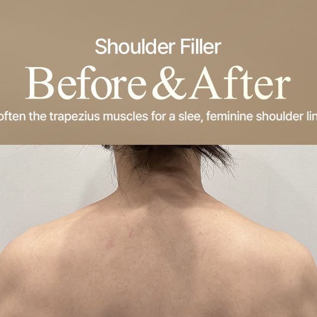 Shoulder filler before and after