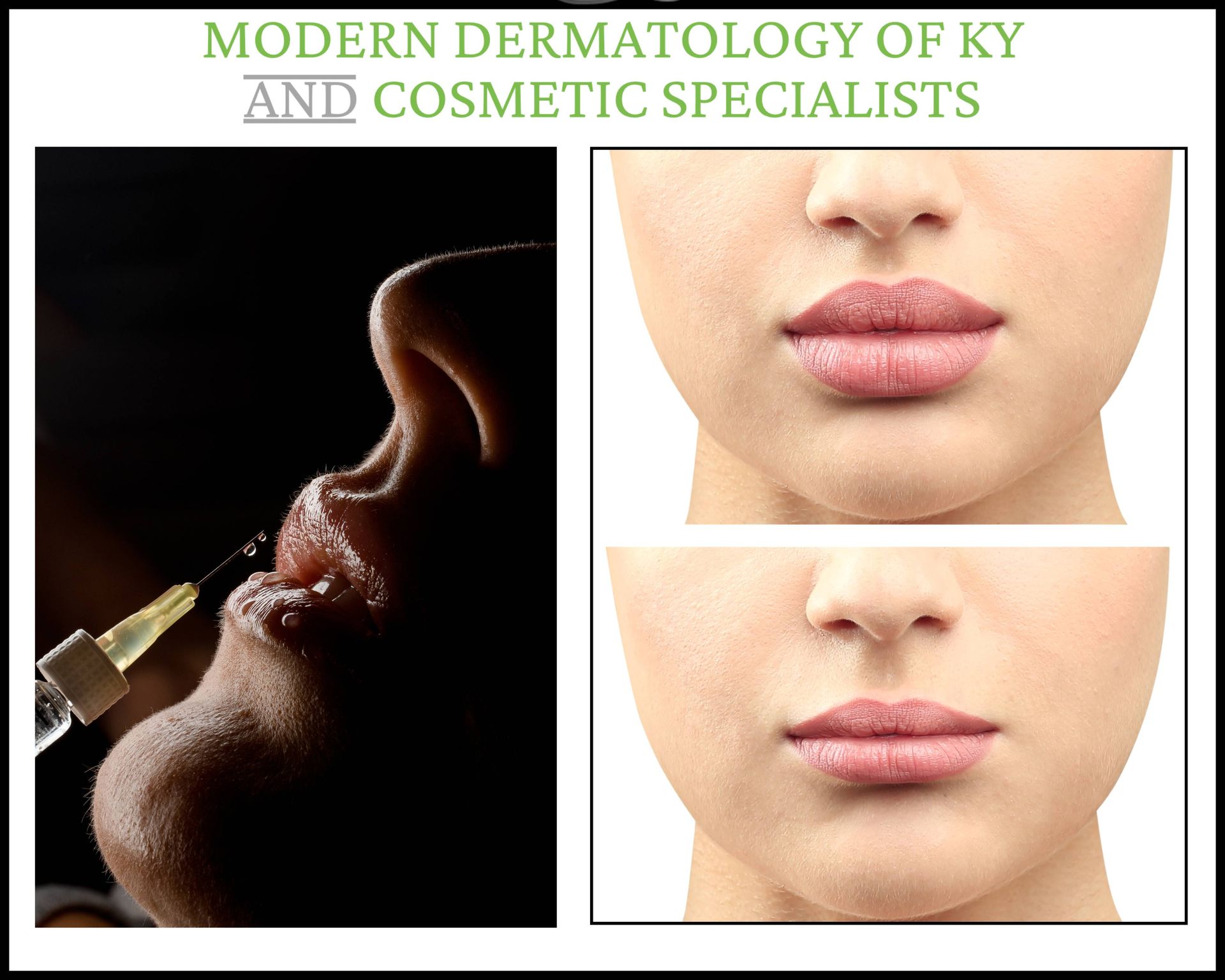 botox-lip-flip-before-and-after-gummy-smile-correction