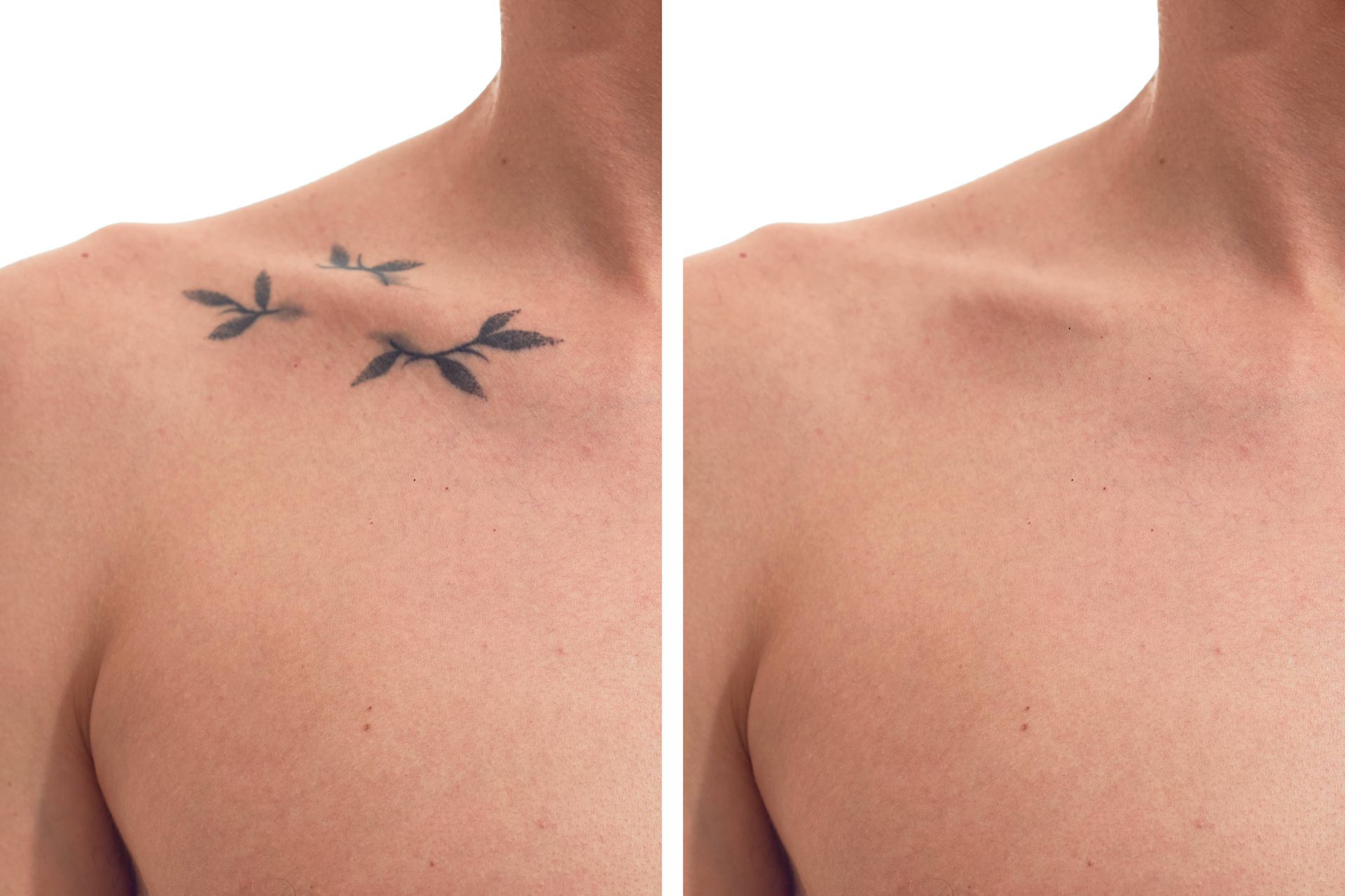 Need Help Fixing a Tattoo? | Modern Dermatology of KY