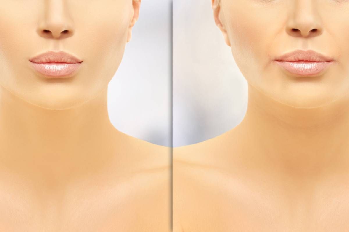 A woman’s face with Restylane Before and After near Lexington, London, Richmond, and Paris, Kentucky (KY)