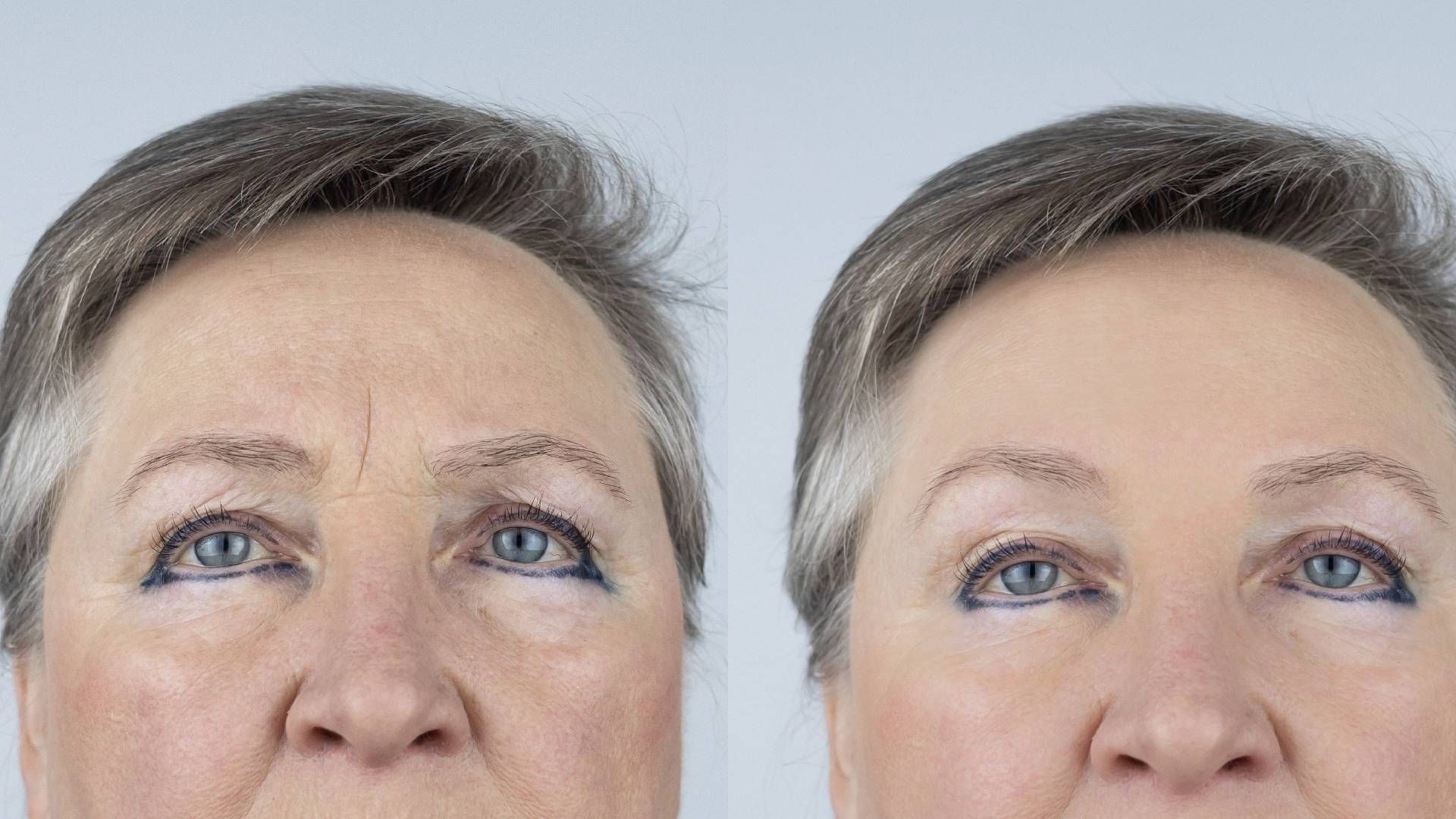 Seven Days of Botox: What to Expect? | Modern Dermatology of KY