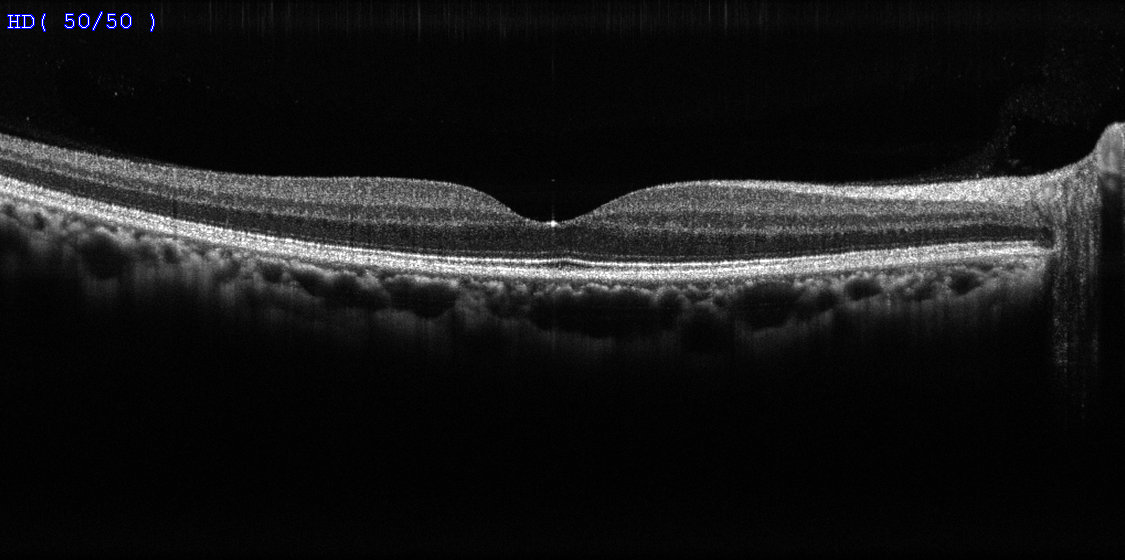 Grayscale Retinal Scan Showing the Layered Structure of The Eye — Clear Optometry In Bargara, QLD