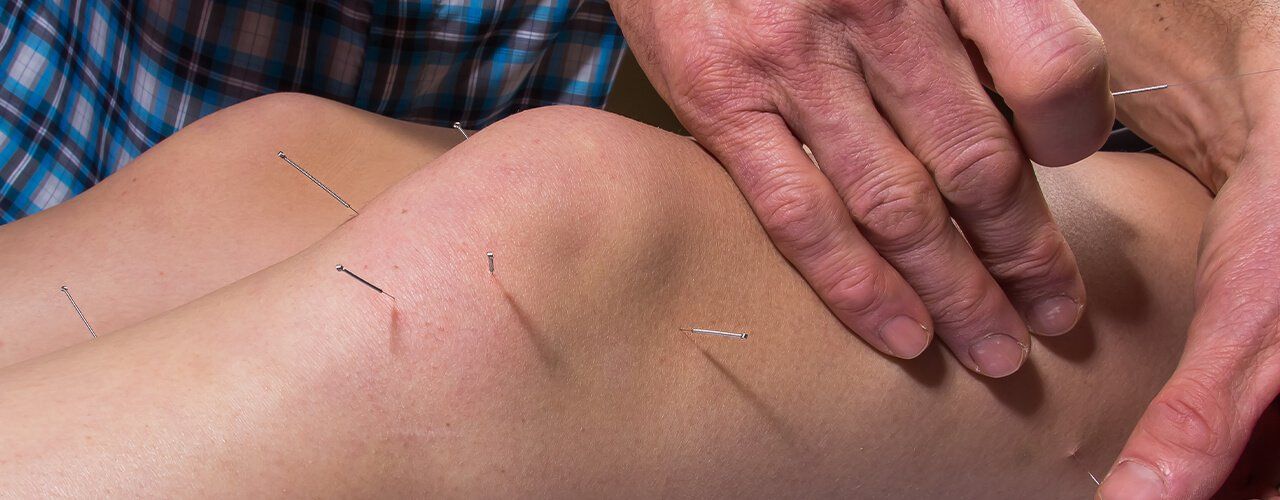 Dry Needling