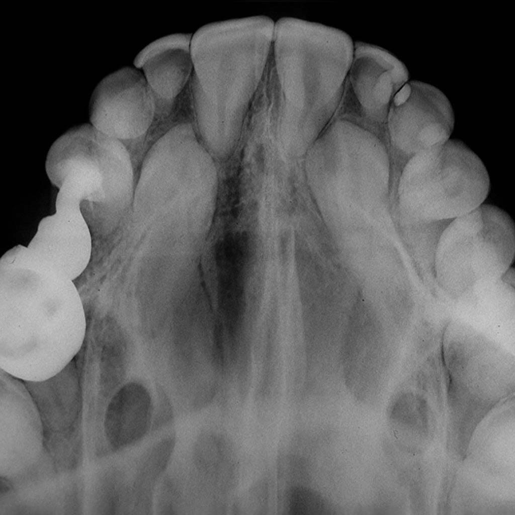 PERIAPICAL