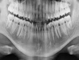 OCLUSAL