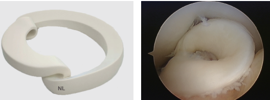 Dispositivo médico branco em forma de anel ao lado de uma imagem endoscópica do mesmo inserido no tecido.