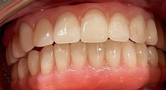 Close-up of a smiling mouth showing upper and lower teeth and pink gums
