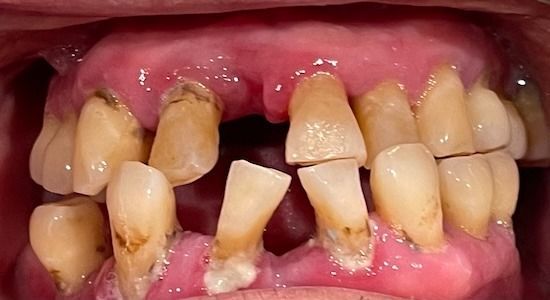 Severely damaged front teeth with broken, discolored, and missing upper and lower teeth