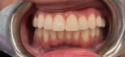 Close-up of teeth with dental retractors, showing upper and lower front teeth open wide.