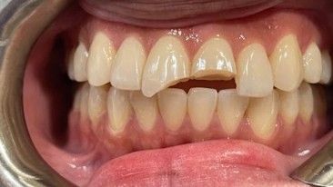 Close-up of an open mouth showing teeth with a visible gap between the upper front teeth