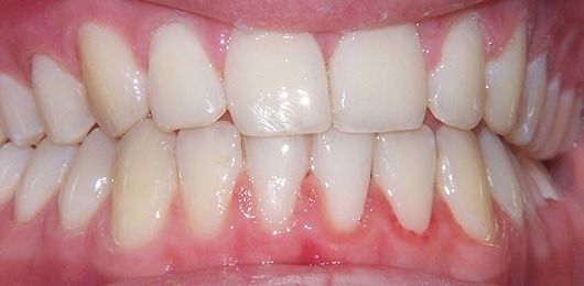 Close-up of teeth and gums with braces, showing upper and lower front teeth aligned.
