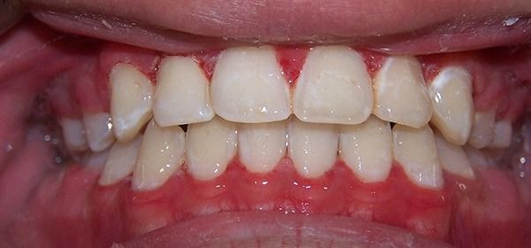 Close-up of teeth with a visible gap and redness on the gums