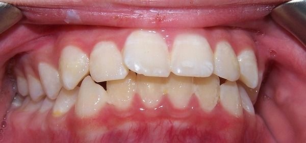 Close-up of teeth with visible crowding and slight misalignment, front mouth open