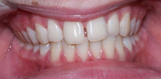 Close-up of a smiling mouth showing white teeth and pink gums