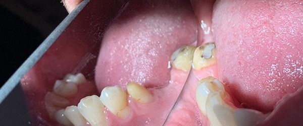 Close-up of teeth being cleaned with a dental tool, showing yellow plaque buildup.