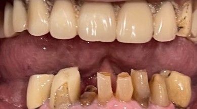 Close-up of a mouth showing upper front teeth and severely damaged lower teeth with missing and decayed areas.