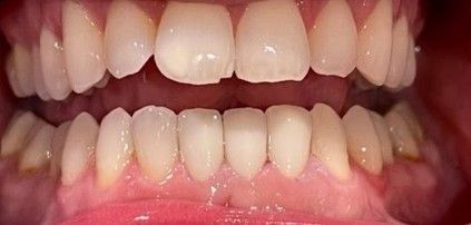 Close-up of a person's mouth with visible upper and lower teeth, lips slightly parted.