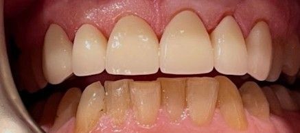 Close-up of open mouth showing upper and lower front teeth with visible gaps and discoloration