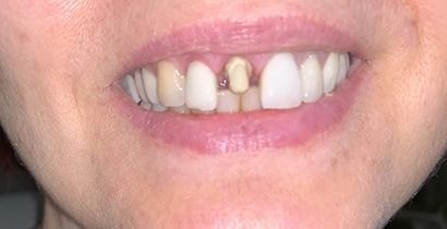Close-up of a smiling mouth with missing front teeth and a small, misaligned tooth
