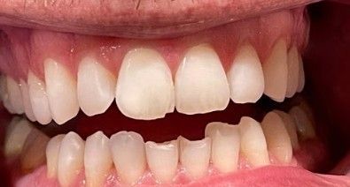 Close-up of a mouth with upper teeth and a prominent gap between the front teeth