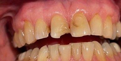 Close-up of teeth with a noticeable gap and chipped upper front tooth