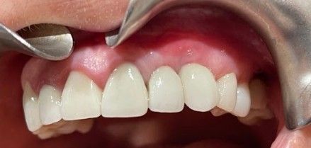 Close-up of upper front teeth with a retractor pulling back the lips during a dental exam